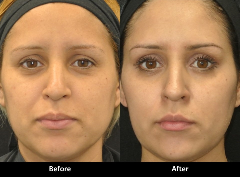 Liquid Facelift before and after
